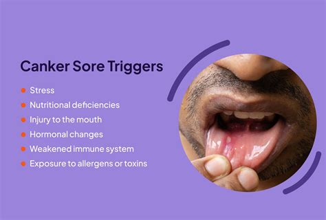 Canker sore causes, treatment and symptom relief .